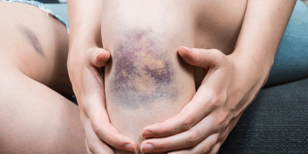 Cómo las Condiciones Médicas Preexistentes Afectan Tu Caso de Lesiones Personales: Hechos y Mitos